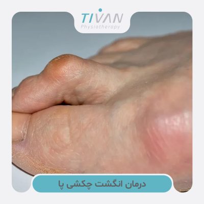 درمان انگشت چکشی پا