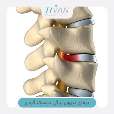 درمان بیرون زدگی دیسک گردن
