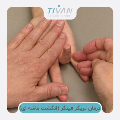 درمان تریگر فینگر (انگشت ماشه ای)