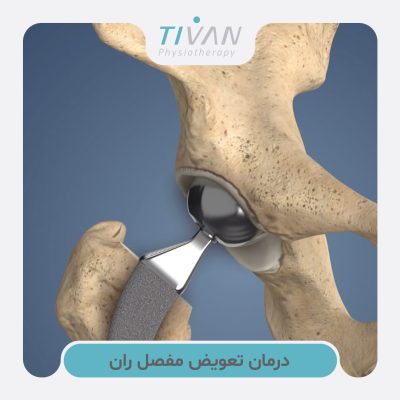 درمان تعویض مفصل ران