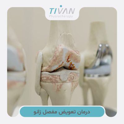 درمان تعویض مفصل زانو