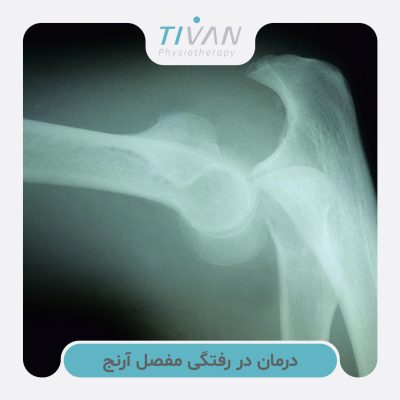 درمان در رفتگی مفصل آرنج