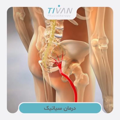 درمان سیاتیک