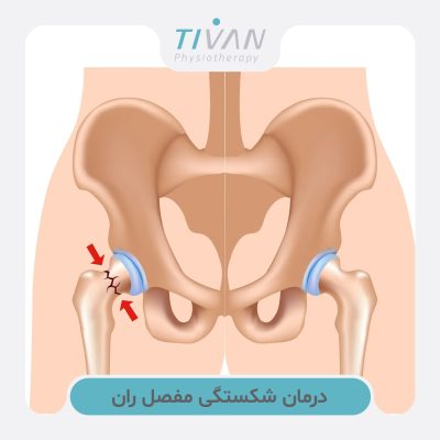 درمان شکستگی مفصل ران