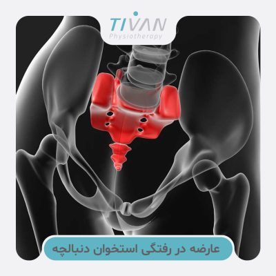 درمان عارضه در رفتگی استخوان دنبالچه