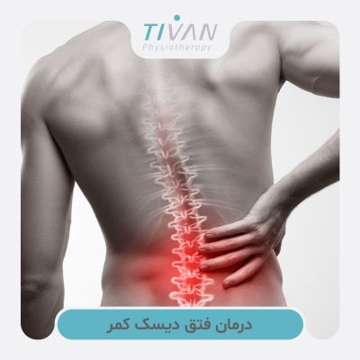 درمان فتق دیسک کمر