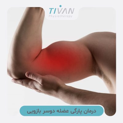 درمان پارگی عضله دوسر بازویی