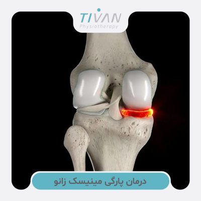 درمان پارگی مینیسک زانو