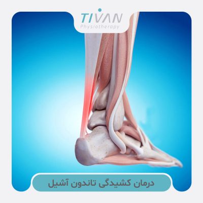 درمان کشیدگی تاندون آشیل